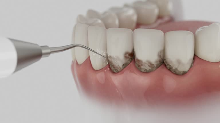 Trusted Wisdom Tooth Removal service in Mount Olive, AL - Dentist Open Now